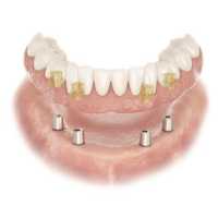 Affordable Dental Implant Excellence/ Implant Dentures/ TMJ and Headaches/ Thomas E. Bramanti, DDS, PHD, INC Logo