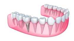Dr Naser Sharifi Implant Dentistry