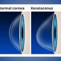 keratoconus vision center Logo