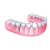 Dr Naser Sharifi Implant Dentistry Logo
